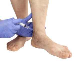 Spider Vein Treatment: Sclerotherapy or Laser Vein Treatment?